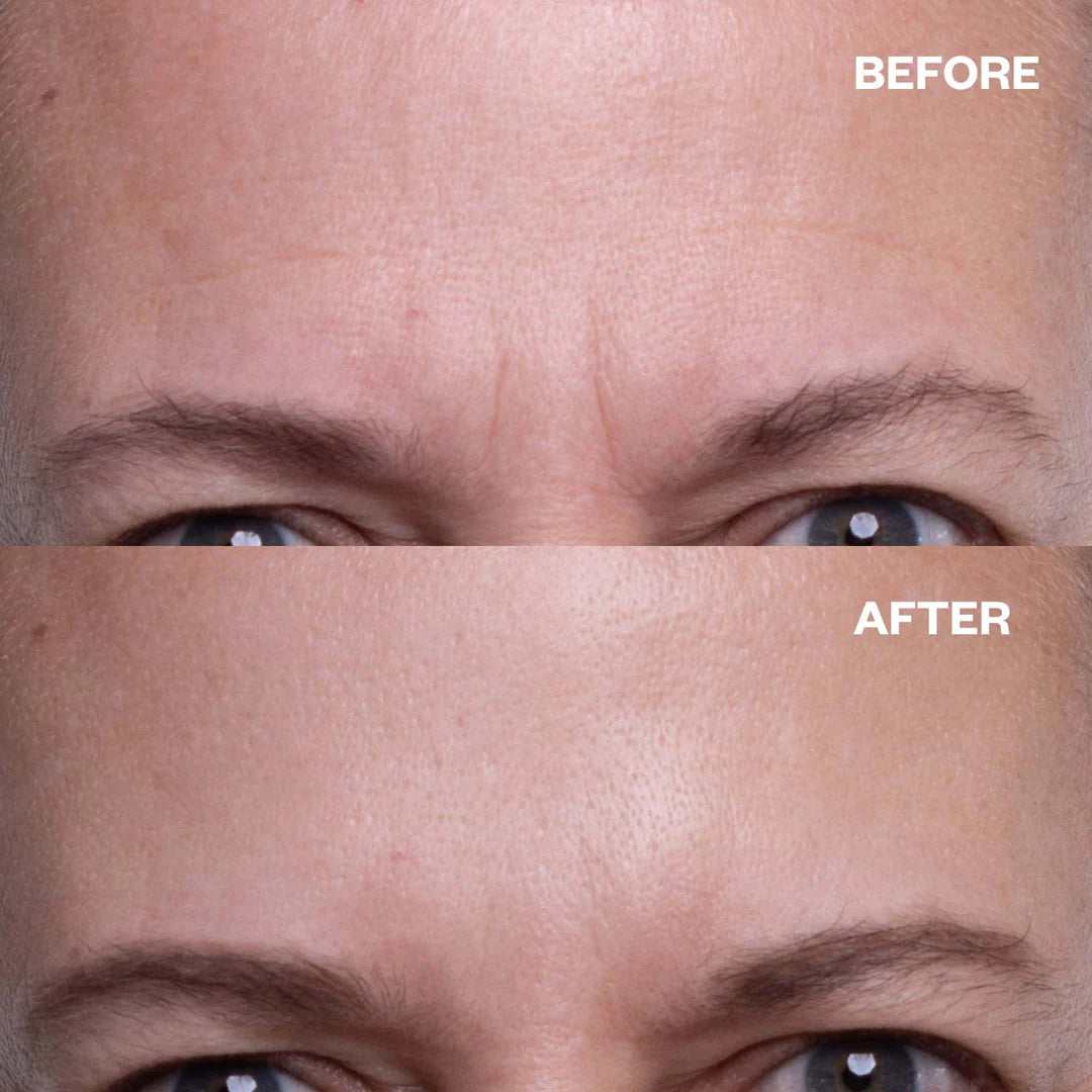 Aleynae™ Forehead Wrinkle Patches