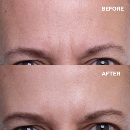 Aleynae™ Forehead Wrinkle Patches